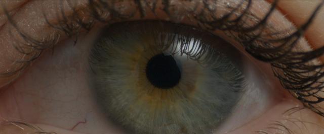 Thyroid eye disease